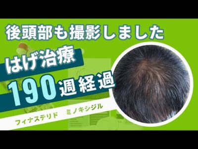 【はげ治療 190週経過 AGA 改善】フィナステリドとミノキシジルで挑む３年超のハゲ改善！！おっさんのAGA治療・はげ改善【FincarとFOLLICS】
