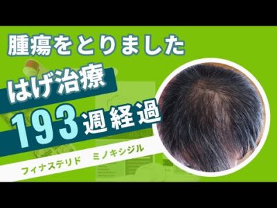 【はげ治療 193週経過 AGA 改善】あきらめたらそこで終わり！フィナステリドとミノキシジルで挑む３年超のハゲ改善！！おっさんのAGA治療・はげ改善【FincarとFOLLICS】