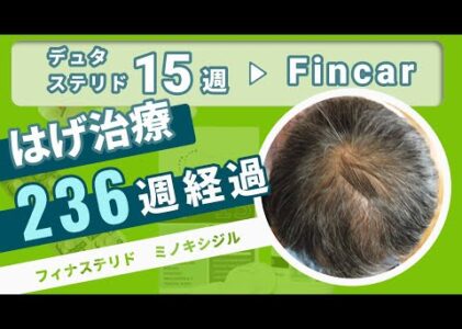 【はげ治療 236週経過 AGA 改善】あきらめたらそこで終わり！フィンカーとミノキシジルで挑む4年超のハゲ改善！デュタステリド使用終了！【FincarとFOLLICS】