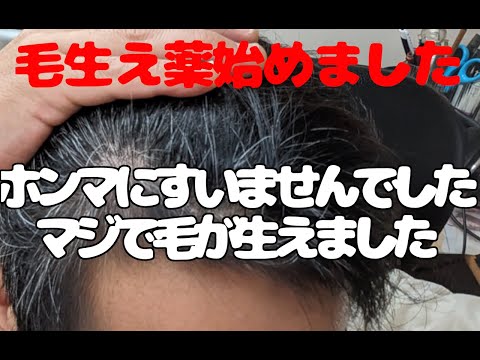 【毛生え薬】疑ってすみませんでした！！フィナクス＆ミノクソールでマジで生えてきました！