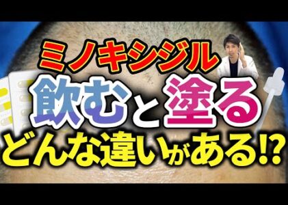 【ミノキシジル】飲み薬と塗り薬どっちの方が改善する！？