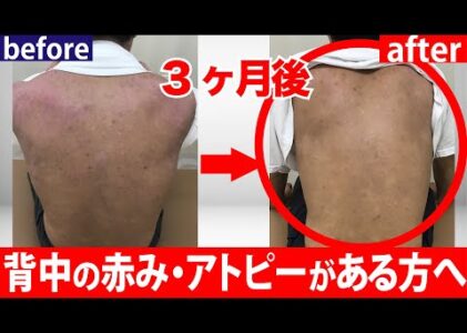 【背中のかゆみと赤み】アトピー肌を薬に頼らず改善する方法