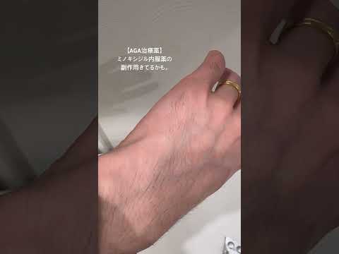 【AGA治療薬の副作用】わかる？　#aga治療 #美容自己投資 #薄毛治療 #40代