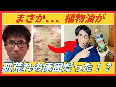 植物油をやめたらアトピー・肌荒れが劇的改善！