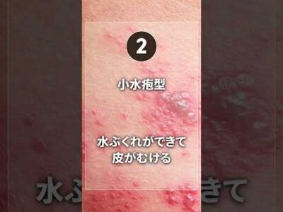 【夏に急増】水虫の症状・感染経路・治療法