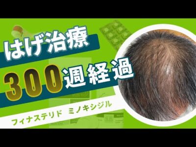 【はげ治療 300週経過 AGA 改善】5年突入継続中！！髪を取り戻せ！あきらめたらそこで終わり！フィナステリドとミノキシジルで挑むハゲ改善！【FincarとFOLLICS】