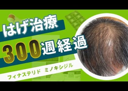 【はげ治療 300週経過 AGA 改善】5年突入継続中！！髪を取り戻せ！あきらめたらそこで終わり！フィナステリドとミノキシジルで挑むハゲ改善！【FincarとFOLLICS】